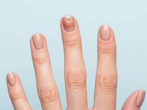 Cómo prevenir y tratar los hongos en las uñas