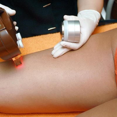 ¿Se puede depilar con láser en verano?